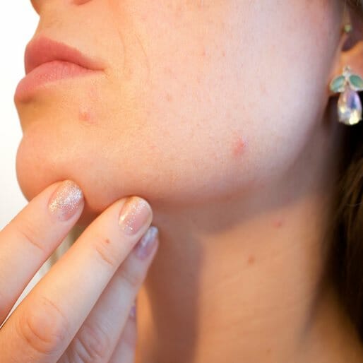 What Your Adult Acne is Telling You About Your Health