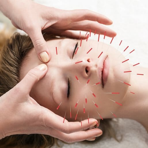 You May Be Convinced to Try Acupuncture After Reading This