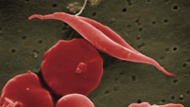 The FDA Has Approved a New Sickle Cell Drug for the First Time in 20 Years