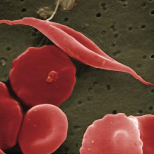 The FDA Has Approved a New Sickle Cell Drug for the First Time in 20 Years